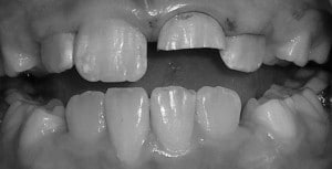 a chipped front tooth prior to fixing